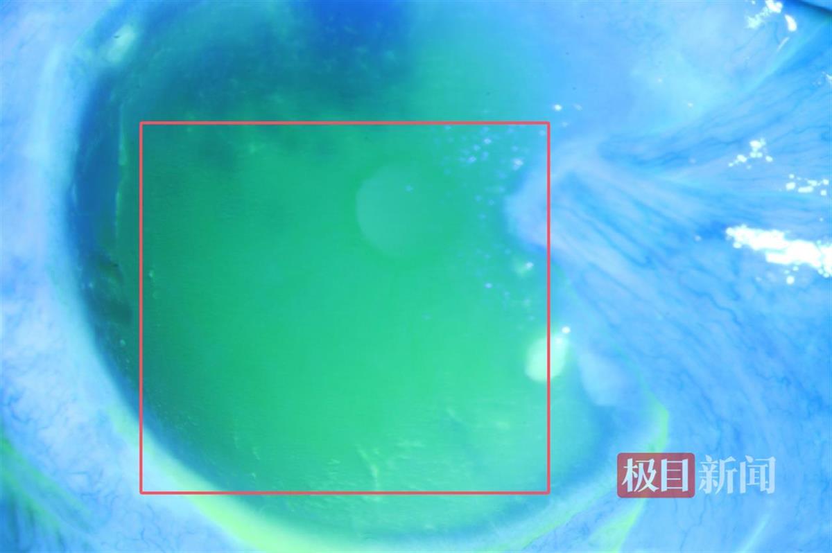 隐翅虫爬过眼睛，男子角膜瞬间灼伤受损，医生：这种虫子不能碰！