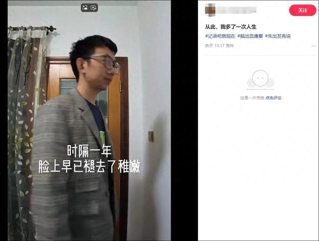 长期7点起凌晨一两点睡！35岁程序员脑干出血抢救了28天
