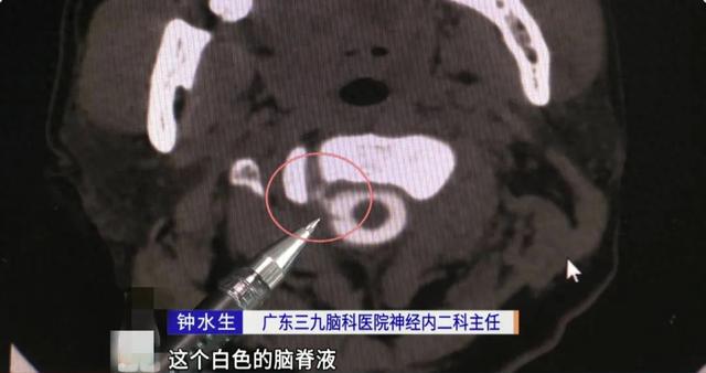 可怕！32岁男子脑子“漏水”竟与这个动作有关！