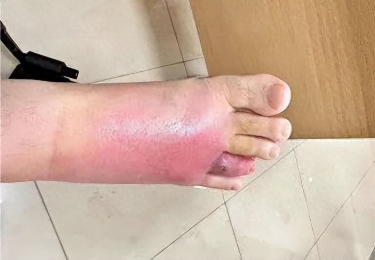 在沙发上睡了一觉，男子差点截趾！近期千万当心