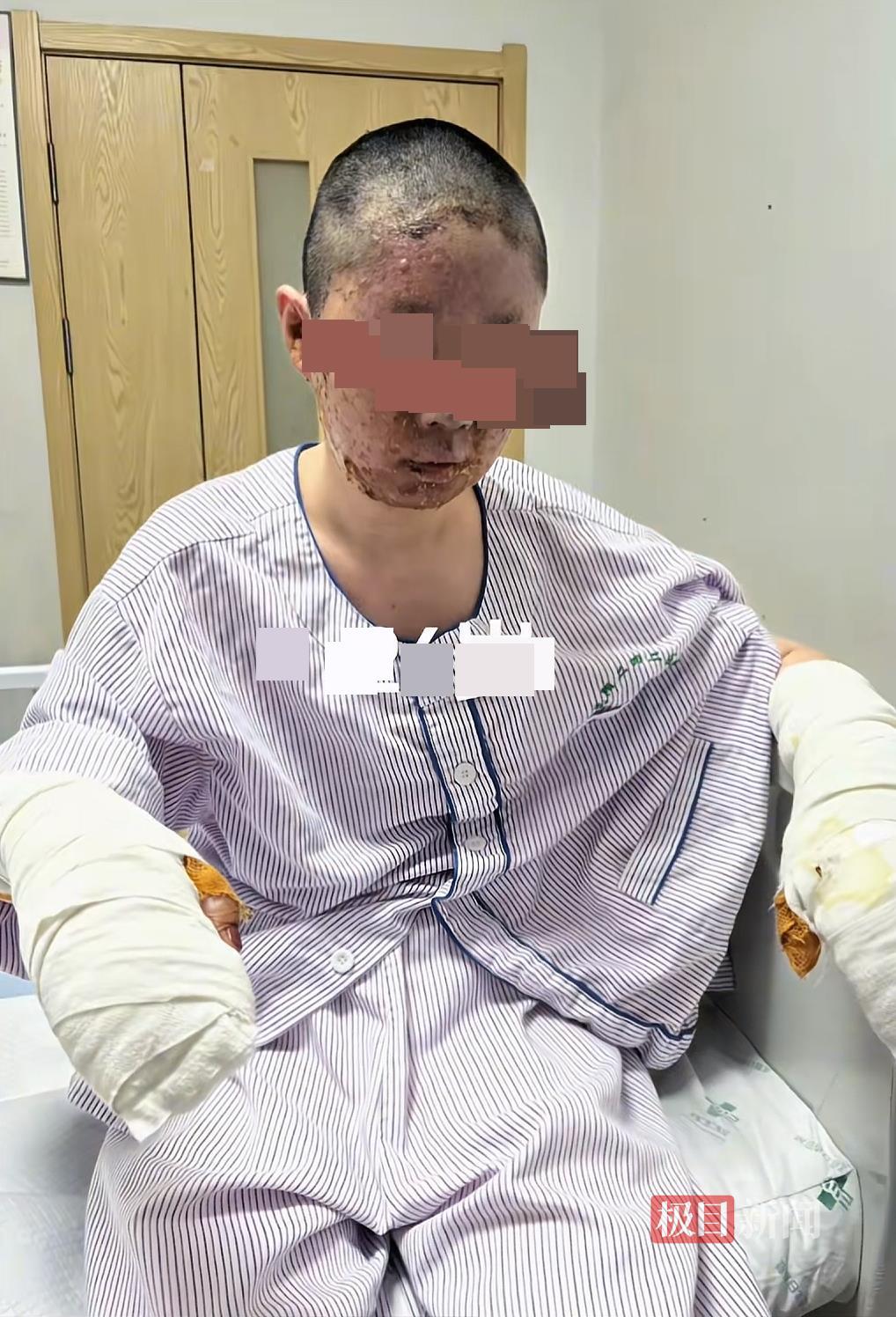 沈阳一美妆博主一家三口因液化气泄漏爆燃烧伤毁容，母亲仍在ICU，当事人回应炒作质疑