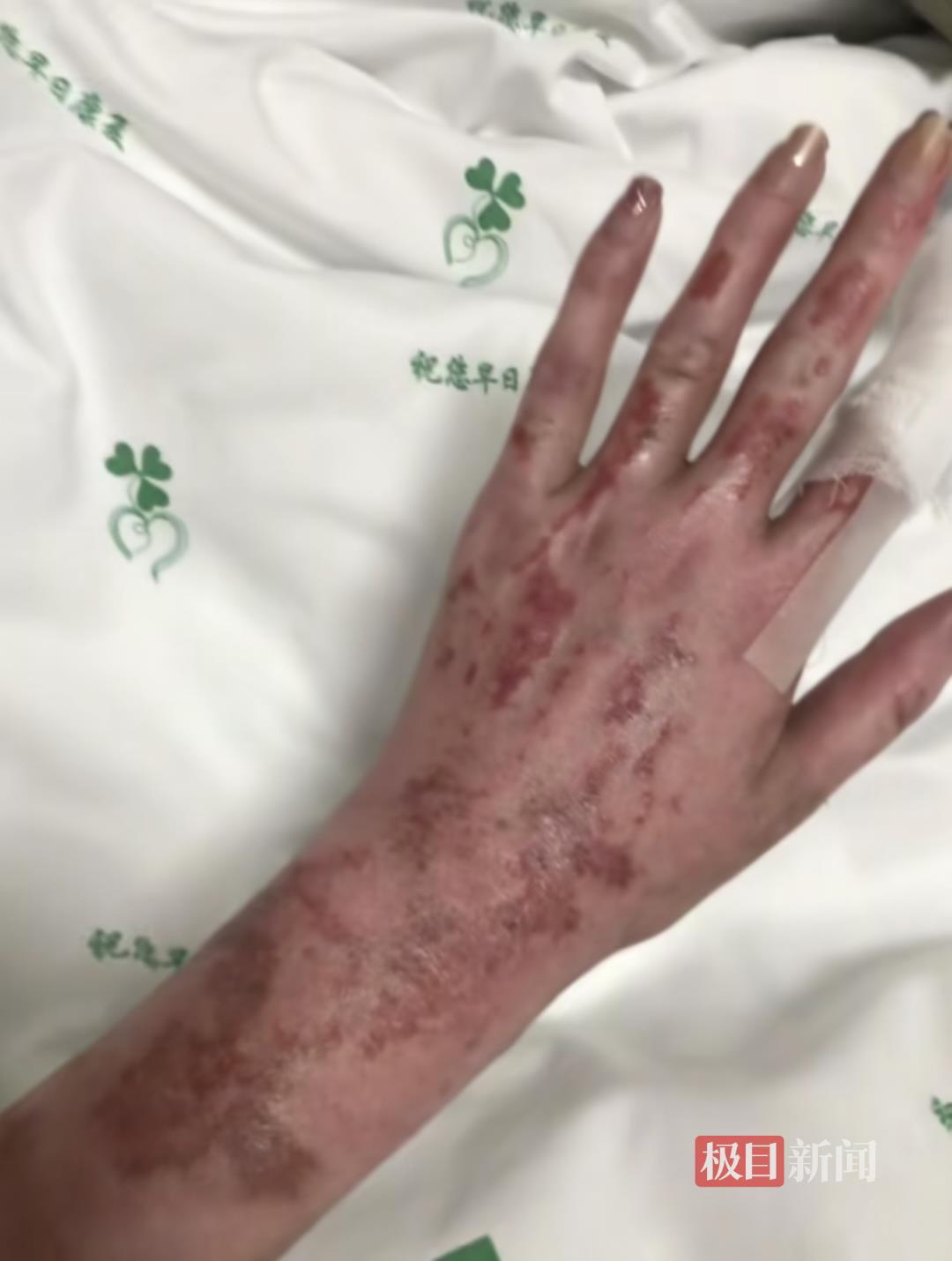 沈阳一美妆博主一家三口因液化气泄漏爆燃烧伤毁容，母亲仍在ICU，当事人回应炒作质疑