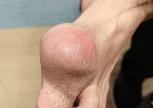 男子大脚趾上长了个“乒乓球”，快一年没法好好穿鞋