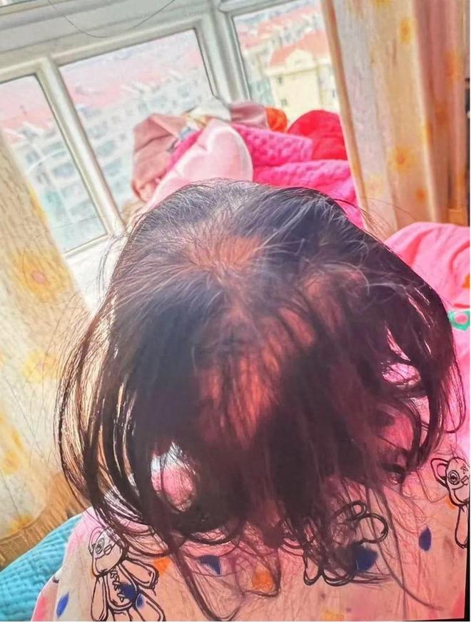 3岁女孩铊中毒，医院独家回应
